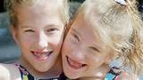 Hensel twins