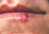 Herpes