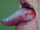 20071112 oral cancer 300x225 HPV Oral Cancer