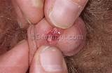 Skin disease: Genital Warts