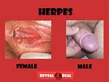 Can You Get Herpes From Oral